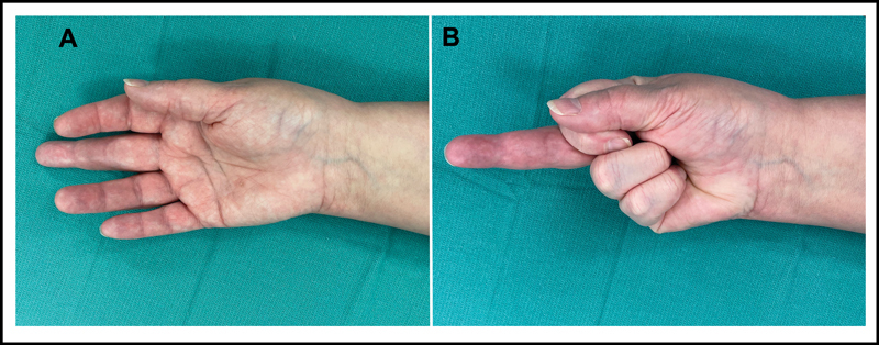 Flexor Tendon Rupture Secondary to Gout.