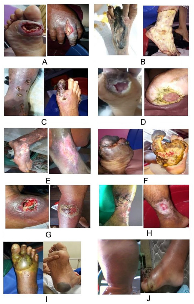 Various Types of Wounds That Diabetic Patients Can Develop: A Narrative Review.