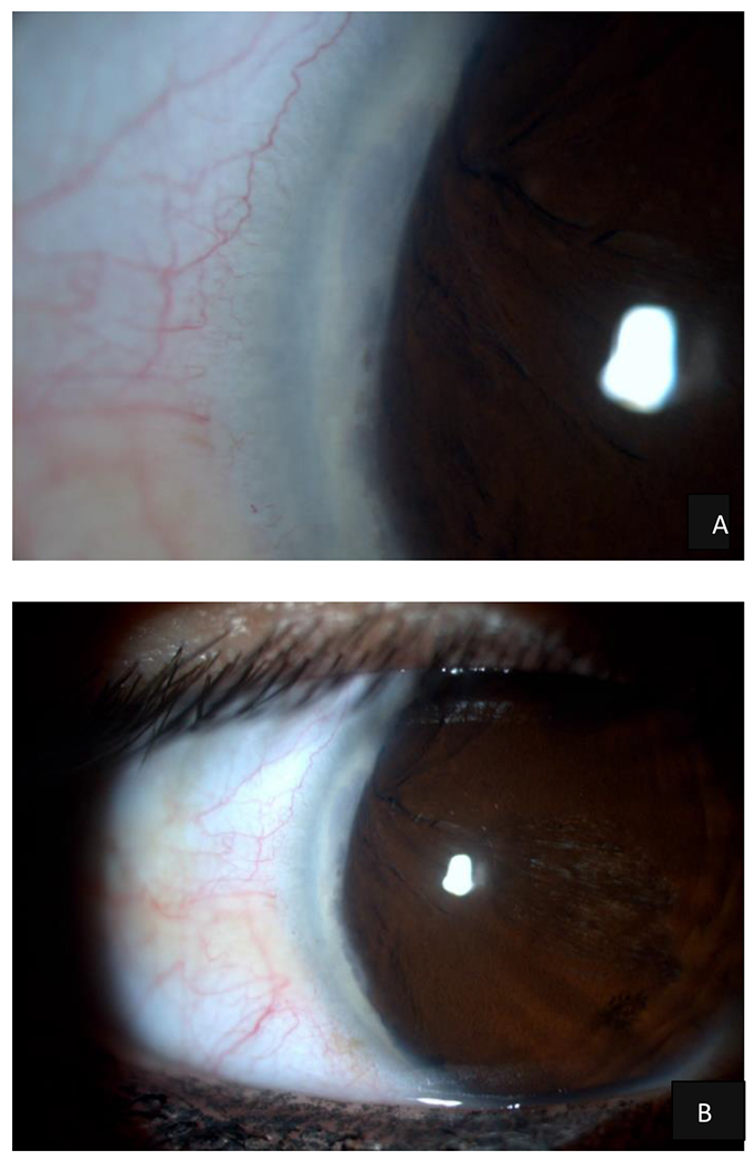 Case Report: Congenital Pseudoacorea in an Ocular Axenfeld-Rieger Syndrome: What is it?