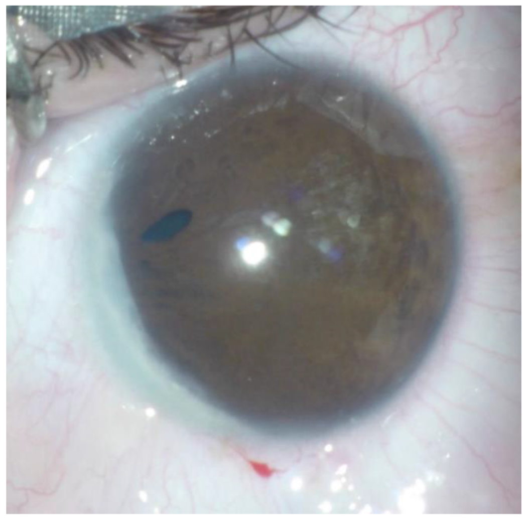 Case Report: Congenital Pseudoacorea in an Ocular Axenfeld-Rieger Syndrome: What is it?