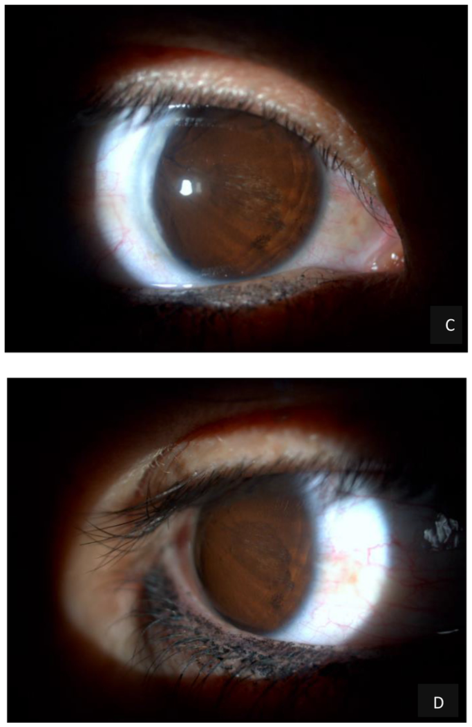 Case Report: Congenital Pseudoacorea in an Ocular Axenfeld-Rieger Syndrome: What is it?