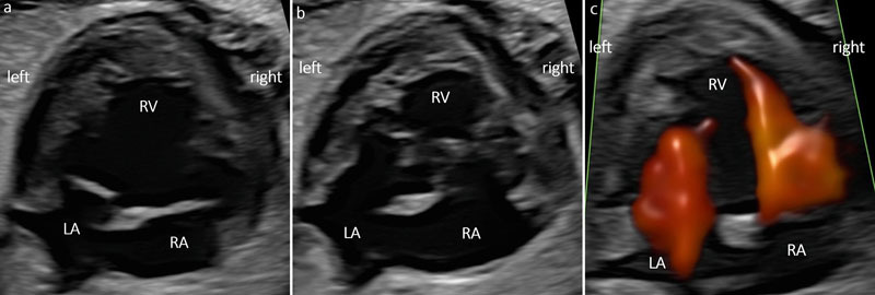 Prenatal Diagnosis, Associated Findings, and Postnatal Outcome in Fetuses with Double Inlet Ventricle (DIV).