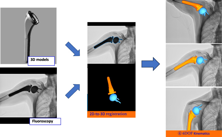 Analysis of in vivo humeral rotation of reverse total shoulder arthroplasty patients during shoulder abduction on the scapular plane with a load.