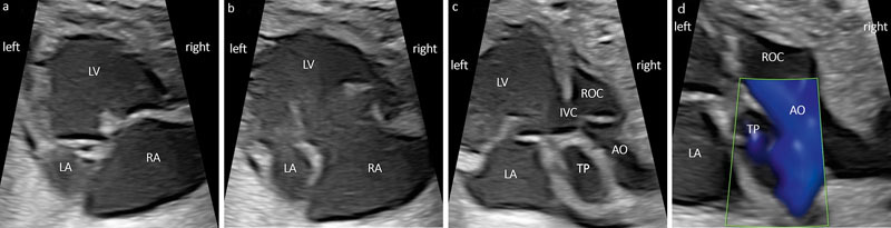 Prenatal Diagnosis, Associated Findings, and Postnatal Outcome in Fetuses with Double Inlet Ventricle (DIV).