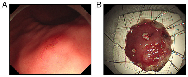 Ectopic gastric mucosa in the submucosa of the stomach: A case report.