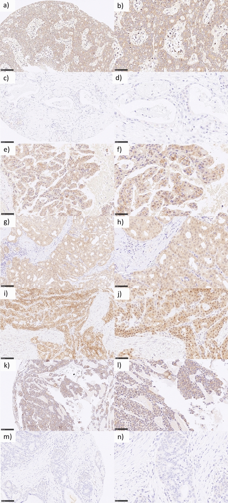 Nectin-4 is frequently expressed in primary salivary gland cancer and corresponding lymph node metastases and represents an important treatment-related biomarker.