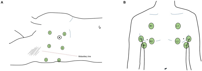 The diagnostic accuracy of lung ultrasound to determine PiCCO-derived extravascular lung water in invasively ventilated patients with COVID-19 ARDS.