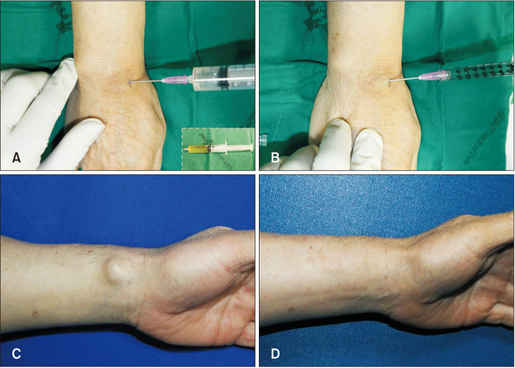 Percutaneous Bleomycin Sclerotherapy: A Useful Therapeutic Option for Ganglion Cysts.