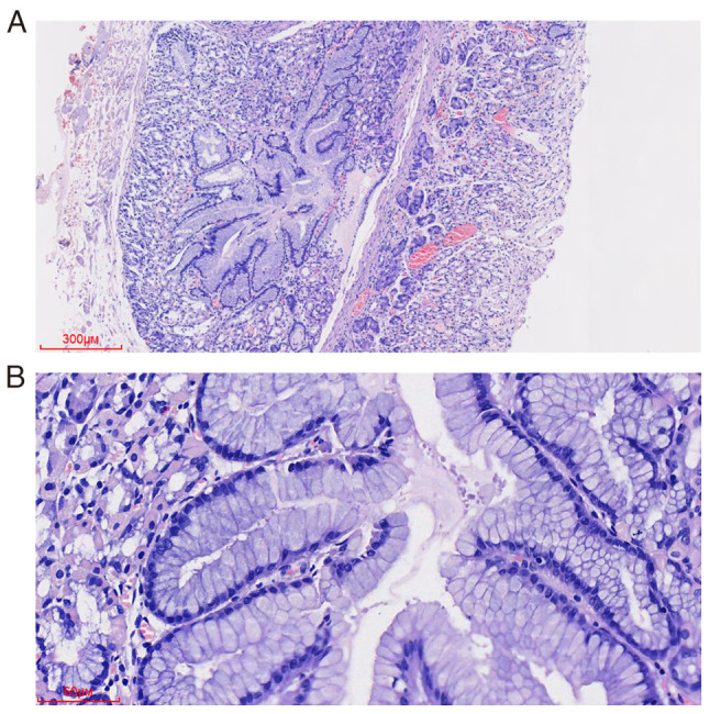 Ectopic gastric mucosa in the submucosa of the stomach: A case report.