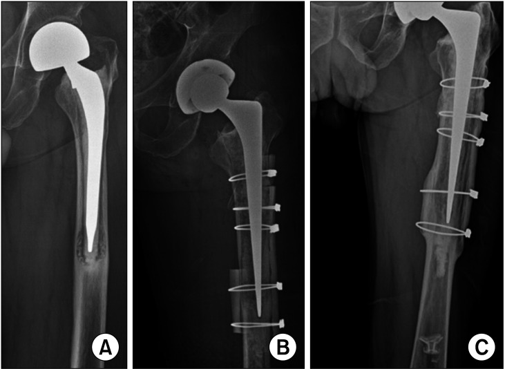 Long-term Follow-up Results of Femoral Revision Hip Arthroplasty Using Impaction Bone Grafting and Standard Cemented Polished Stem.