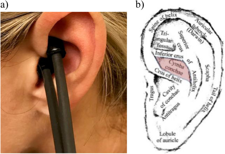 Transcutaneous auricular vagus nerve stimulation attenuates inflammatory bowel disease in children: a proof-of-concept clinical trial.