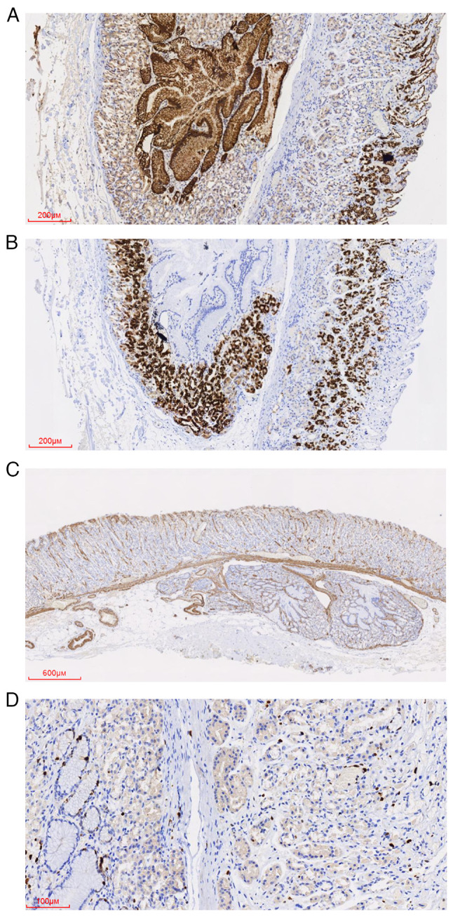 Ectopic gastric mucosa in the submucosa of the stomach: A case report.