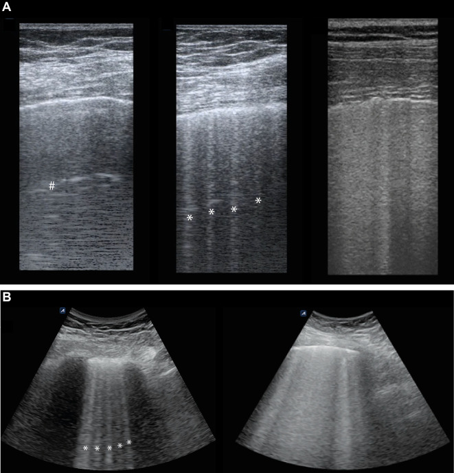 The diagnostic accuracy of lung ultrasound to determine PiCCO-derived extravascular lung water in invasively ventilated patients with COVID-19 ARDS.