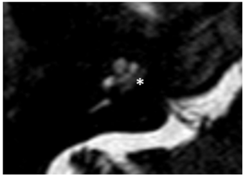 Cavitating Lesions around the Cochlea Can Affect Audiometric Threshold and Clinical Practice.