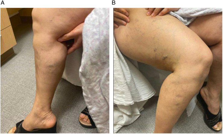 Left Inferior Vena Cava With Infrahepatic Disruption, Azygos Continuation, and Retroaortic Left Renal Vein - A Complex, Symptomatic Caval Anomaly Managed With Endovascular Intervention.