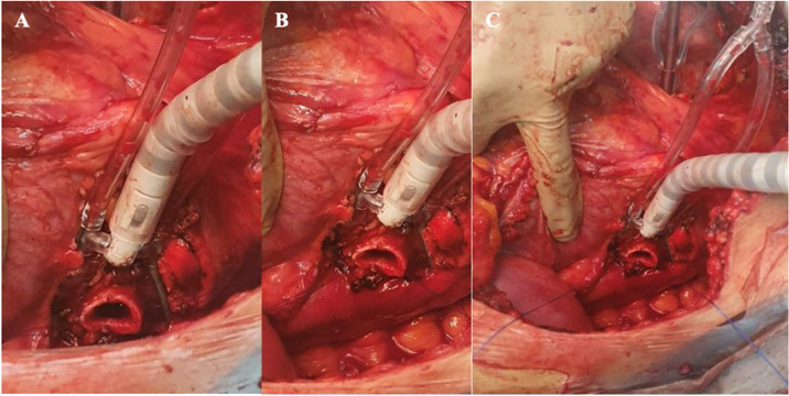 Use of Octopus™ Tissue Stabilizer for Minimal Manipulation Approach of Bronchial Anastomosis in Lung Transplant.