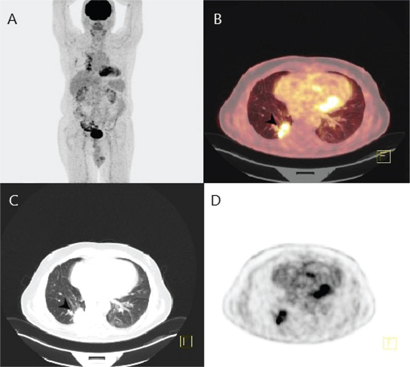 Long-term Intense <sup>18</sup>F-FDG Uptake by the Homeostatic Matrix-associated Inflammatory Response May Mimic Malignancy Recurrence.