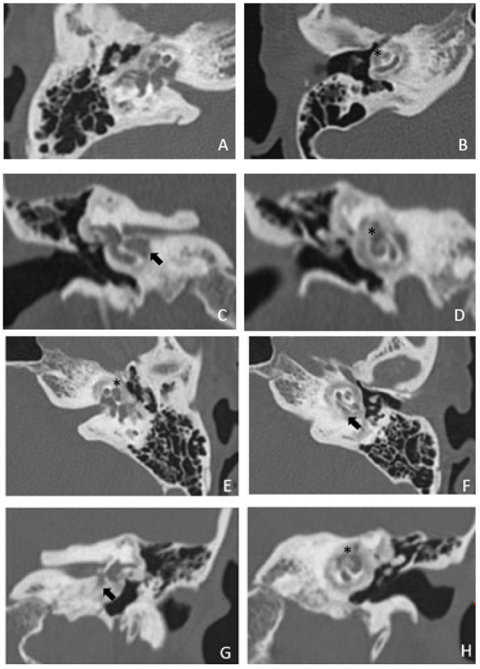 Cavitating Lesions around the Cochlea Can Affect Audiometric Threshold and Clinical Practice.