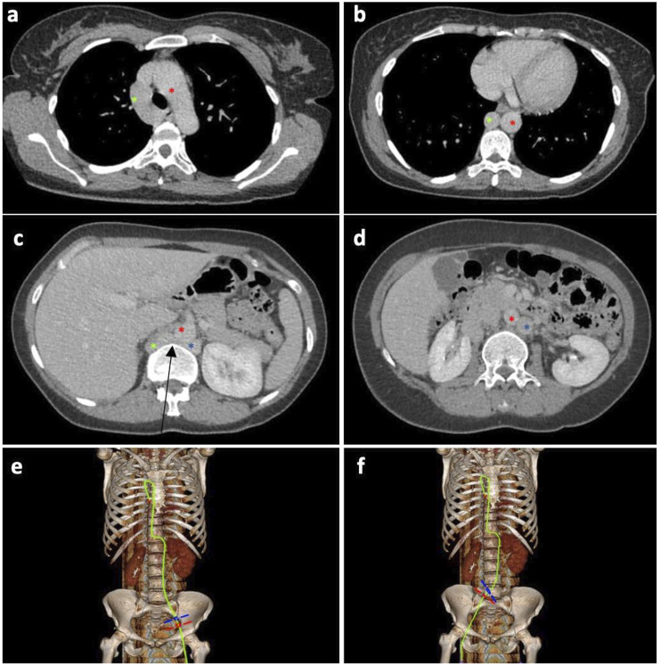 Left Inferior Vena Cava With Infrahepatic Disruption, Azygos Continuation, and Retroaortic Left Renal Vein - A Complex, Symptomatic Caval Anomaly Managed With Endovascular Intervention.