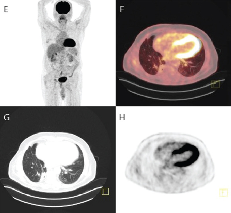 Long-term Intense <sup>18</sup>F-FDG Uptake by the Homeostatic Matrix-associated Inflammatory Response May Mimic Malignancy Recurrence.