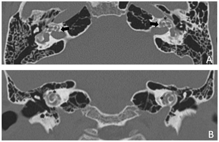 Cavitating Lesions around the Cochlea Can Affect Audiometric Threshold and Clinical Practice.