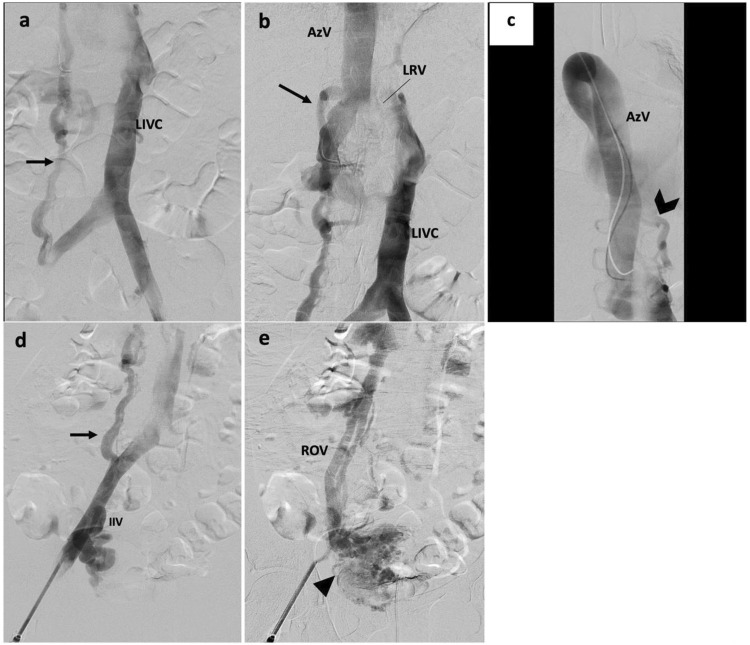 Left Inferior Vena Cava With Infrahepatic Disruption, Azygos Continuation, and Retroaortic Left Renal Vein - A Complex, Symptomatic Caval Anomaly Managed With Endovascular Intervention.