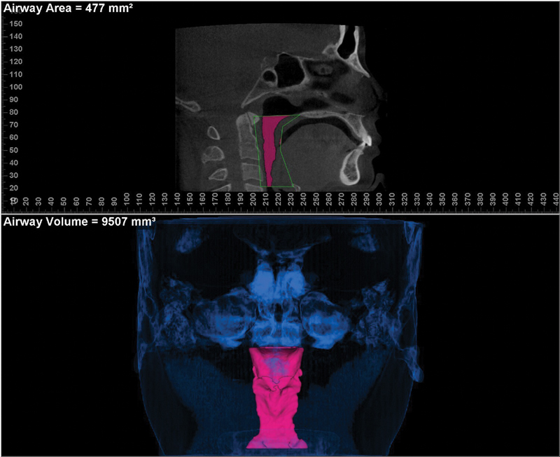 Comparison of Pre- and Posttreatment Airway Volume in Patients with Temporomandibular Joint Disorders Treated with Ultra-Low Frequency Transcutaneous Electrical Nerve Stimulation Using Cone Beam Computed Tomography.