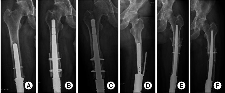 Proximal Femur Salvage in Revision Knee Arthroplasty Due to Oncologic Indications: Long-term Results of Onlay and Overlapping Allograft in Revision Surgeries.