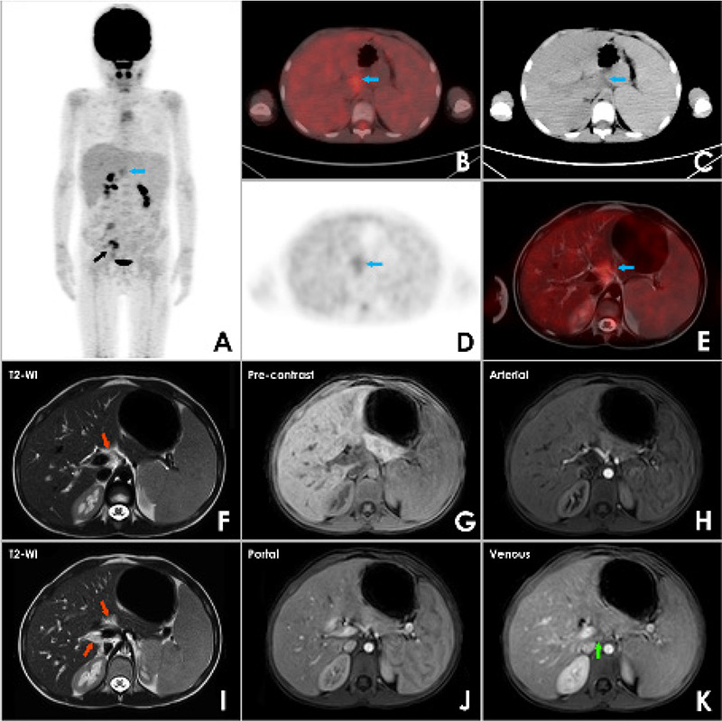 A Rare Case of "Periportal Cuffing" as an Incidental Finding on <sup>18</sup>F-FDG PET/CT.