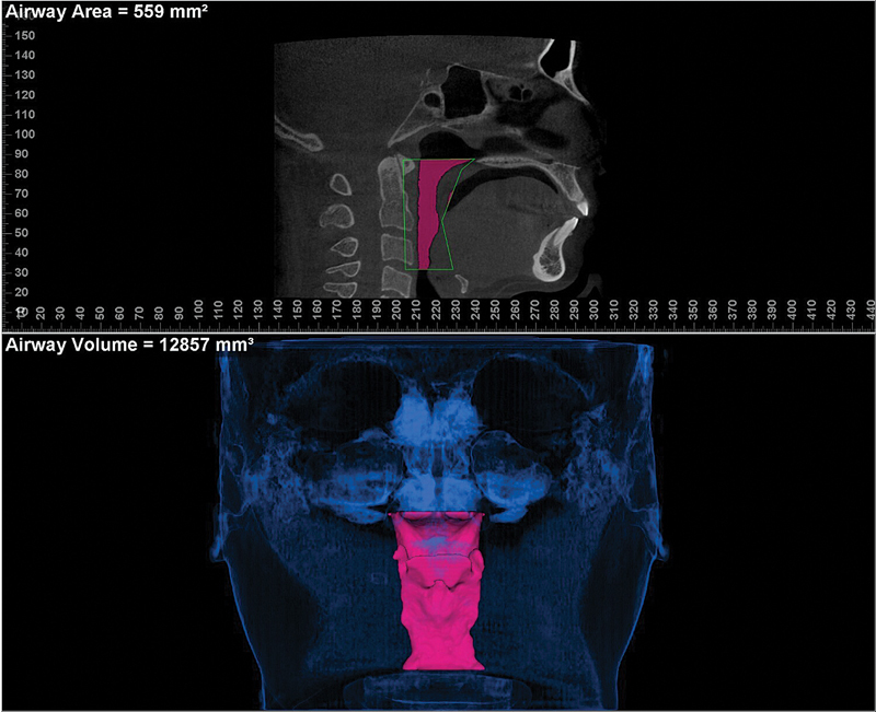 Comparison of Pre- and Posttreatment Airway Volume in Patients with Temporomandibular Joint Disorders Treated with Ultra-Low Frequency Transcutaneous Electrical Nerve Stimulation Using Cone Beam Computed Tomography.