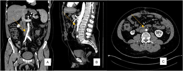 Mycotic Abdominal Aortic Aneurysm Secondary to BCG Therapy for Non-muscle Invasive Urothelial Carcinoma of the Bladder.