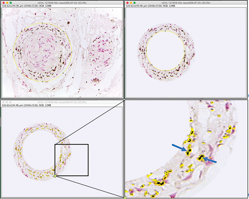 Perivascular Innervation in the Nasal Mucosa and Clinical Findings in Patients with Allergic Rhinitis and Idiopathic Rhinitis.