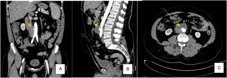 Mycotic Abdominal Aortic Aneurysm Secondary to BCG Therapy for Non-muscle Invasive Urothelial Carcinoma of the Bladder.