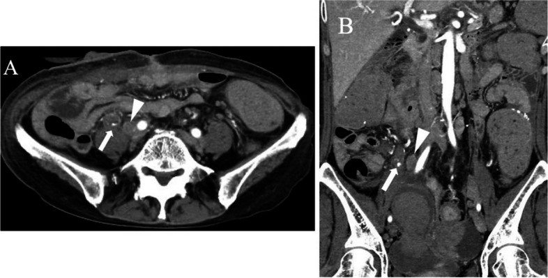 Embolization of pseudoaneurysms in the ureteral branch of the renal artery.