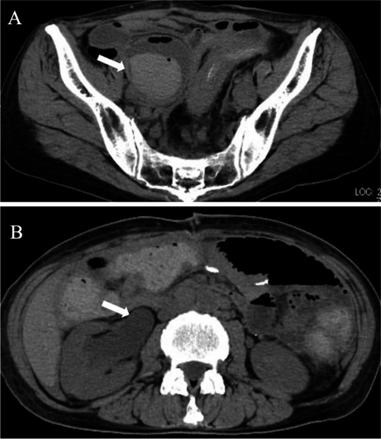 Embolization of pseudoaneurysms in the ureteral branch of the renal artery.