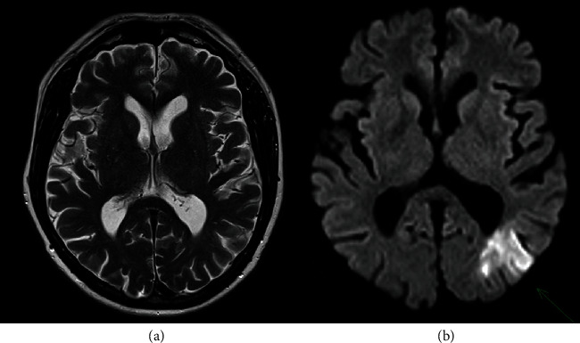 Nonbacterial Thrombotic Endocarditis of Bioprosthetic Aortic Valve Presenting as Cardioembolic Stroke in a Patient without Predisposing Systemic Disease.