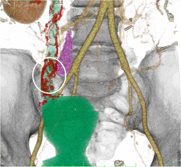 Embolization of pseudoaneurysms in the ureteral branch of the renal artery.