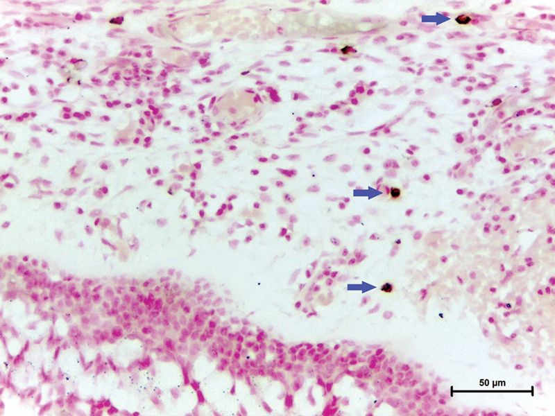 Perivascular Innervation in the Nasal Mucosa and Clinical Findings in Patients with Allergic Rhinitis and Idiopathic Rhinitis.