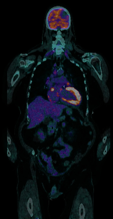 Nonbacterial Thrombotic Endocarditis of Bioprosthetic Aortic Valve Presenting as Cardioembolic Stroke in a Patient without Predisposing Systemic Disease.