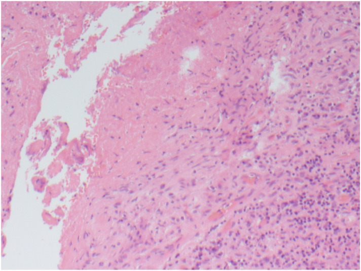 Mycotic Abdominal Aortic Aneurysm Secondary to BCG Therapy for Non-muscle Invasive Urothelial Carcinoma of the Bladder.