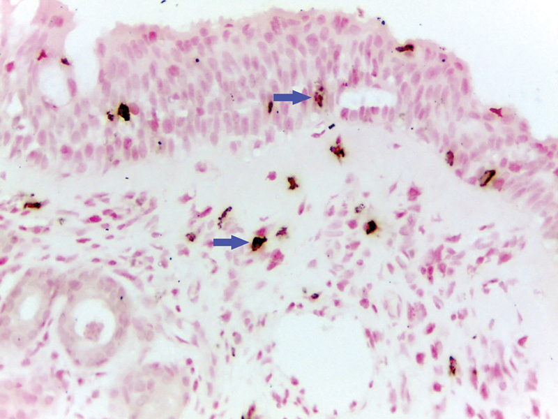 Perivascular Innervation in the Nasal Mucosa and Clinical Findings in Patients with Allergic Rhinitis and Idiopathic Rhinitis.