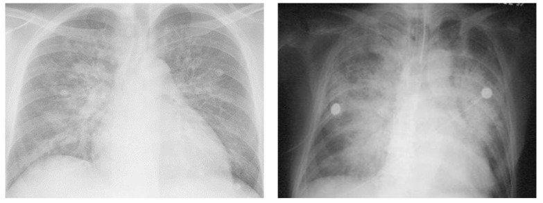 Cardiogenic Pulmonary Edema in Emergency Medicine.