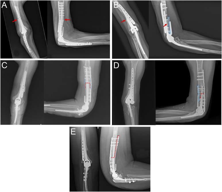 Outcomes of Humeral Allograft-Prosthetic Composites with Plate Fixation in Revision Total Elbow Arthroplasty.