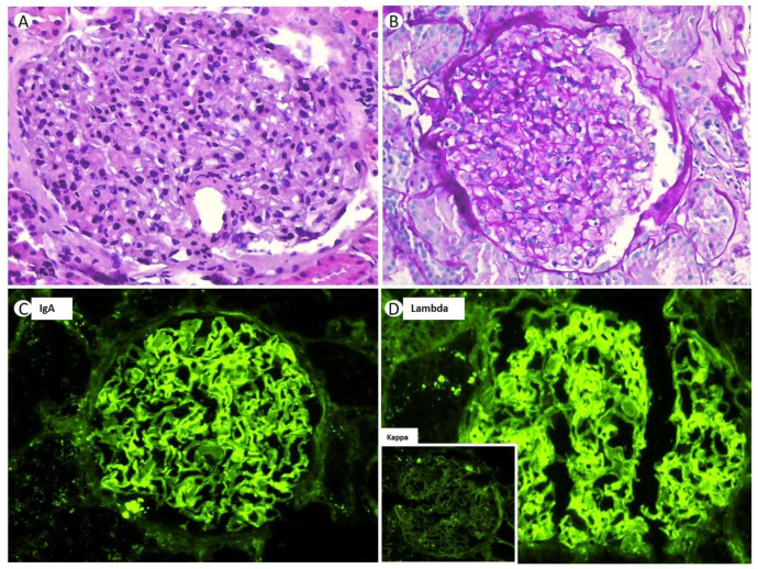 Monoclonal Gammopathy of Renal Significance with Deposits of Infrequent Morphology: Two Case Reports of Light and Heavy Chain Deposition Disease with Atypical Presentation and Literature Review.