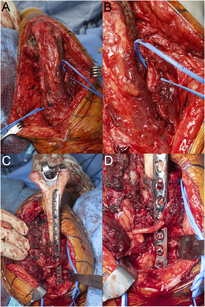 Outcomes of Humeral Allograft-Prosthetic Composites with Plate Fixation in Revision Total Elbow Arthroplasty.