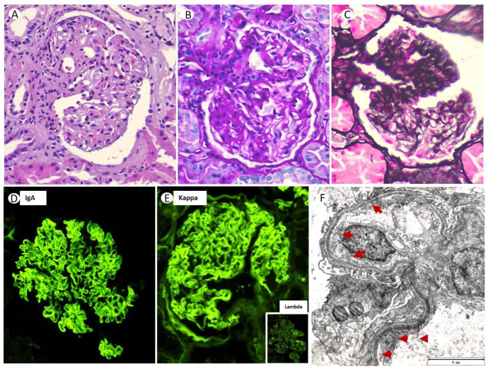 Monoclonal Gammopathy of Renal Significance with Deposits of Infrequent Morphology: Two Case Reports of Light and Heavy Chain Deposition Disease with Atypical Presentation and Literature Review.