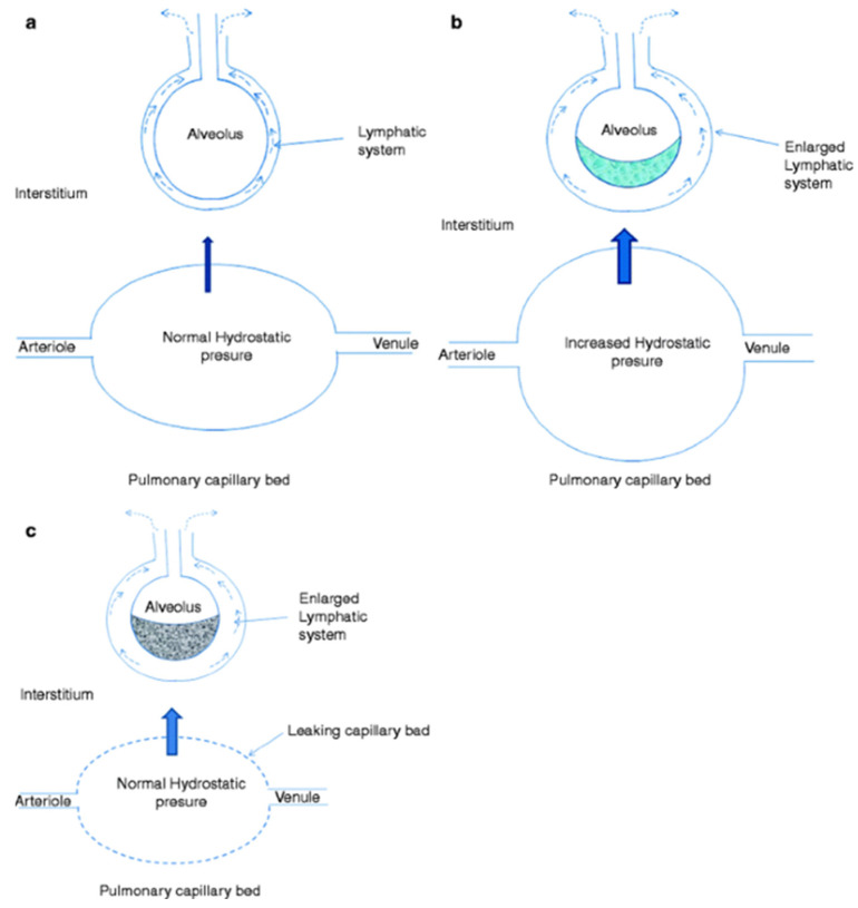 Cardiogenic Pulmonary Edema in Emergency Medicine.