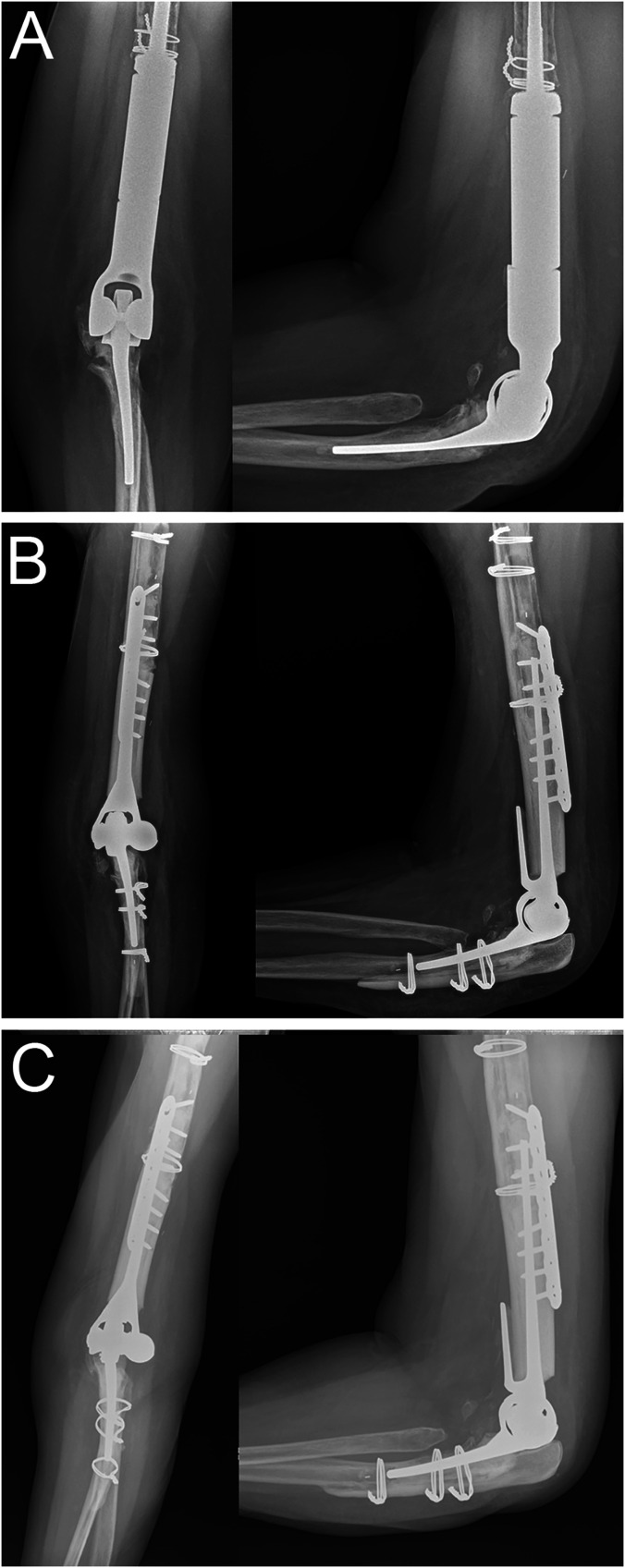 Outcomes of Humeral Allograft-Prosthetic Composites with Plate Fixation in Revision Total Elbow Arthroplasty.