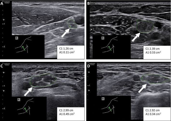 Rare PMP22 variants in mild to severe neuropathy uncorrelated to plasma GDF15 or neurofilament light.