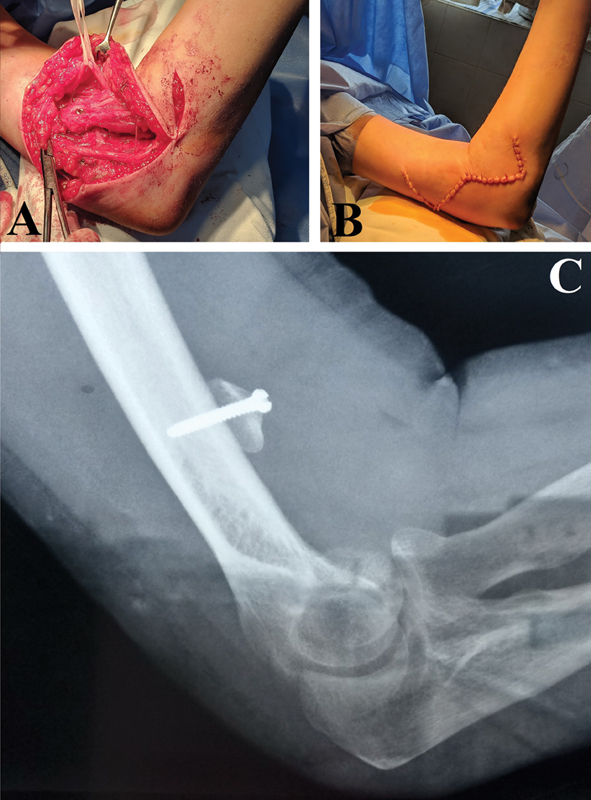 Redefining the Inclusion Criteria for Successful Steindler Flexorplasty Based on the Outcomes of a Case Series in Eight Patients.